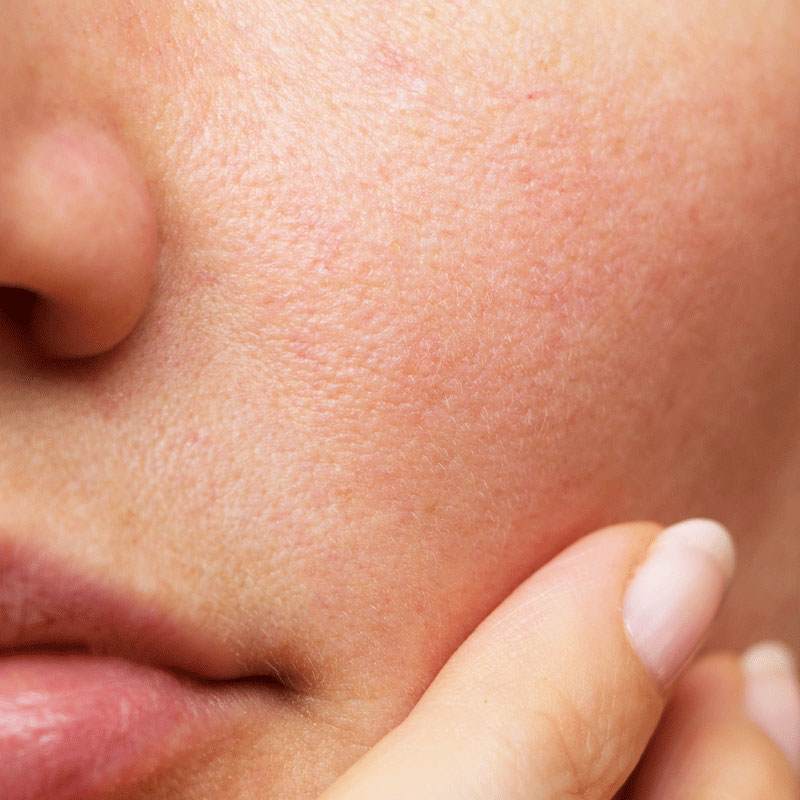 close up on one white woman's cheeks