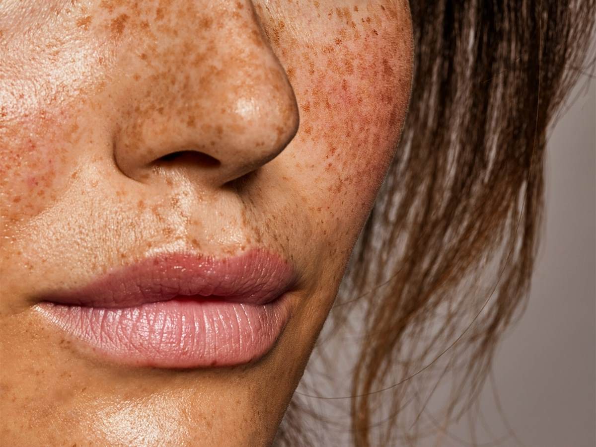 Cropped image showing the nose and mouth of a white woman with very prominent freckles