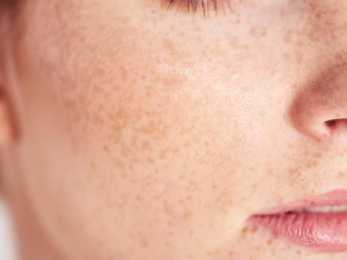 Cropped image showign the cheek of a white woman with prominent freckles