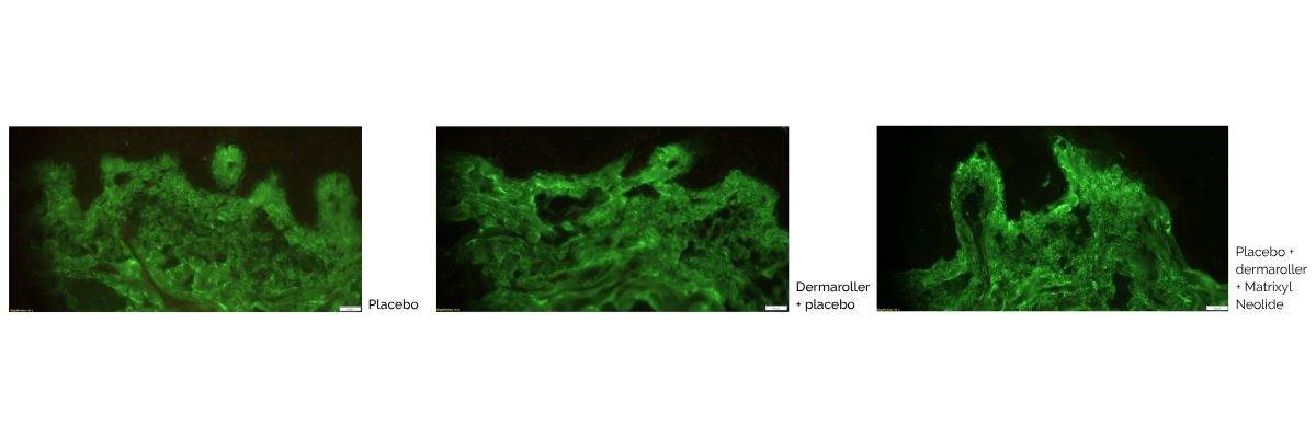 Diagram comparing the amount of collagen produced by placebo, dermaroller and dermaroller + 3% matrixyl neolide treatments. The more the green colour,. the better the treatment. Diagram shows that dermaroller + 3% matrixyl neolide treatment  is the most effective.