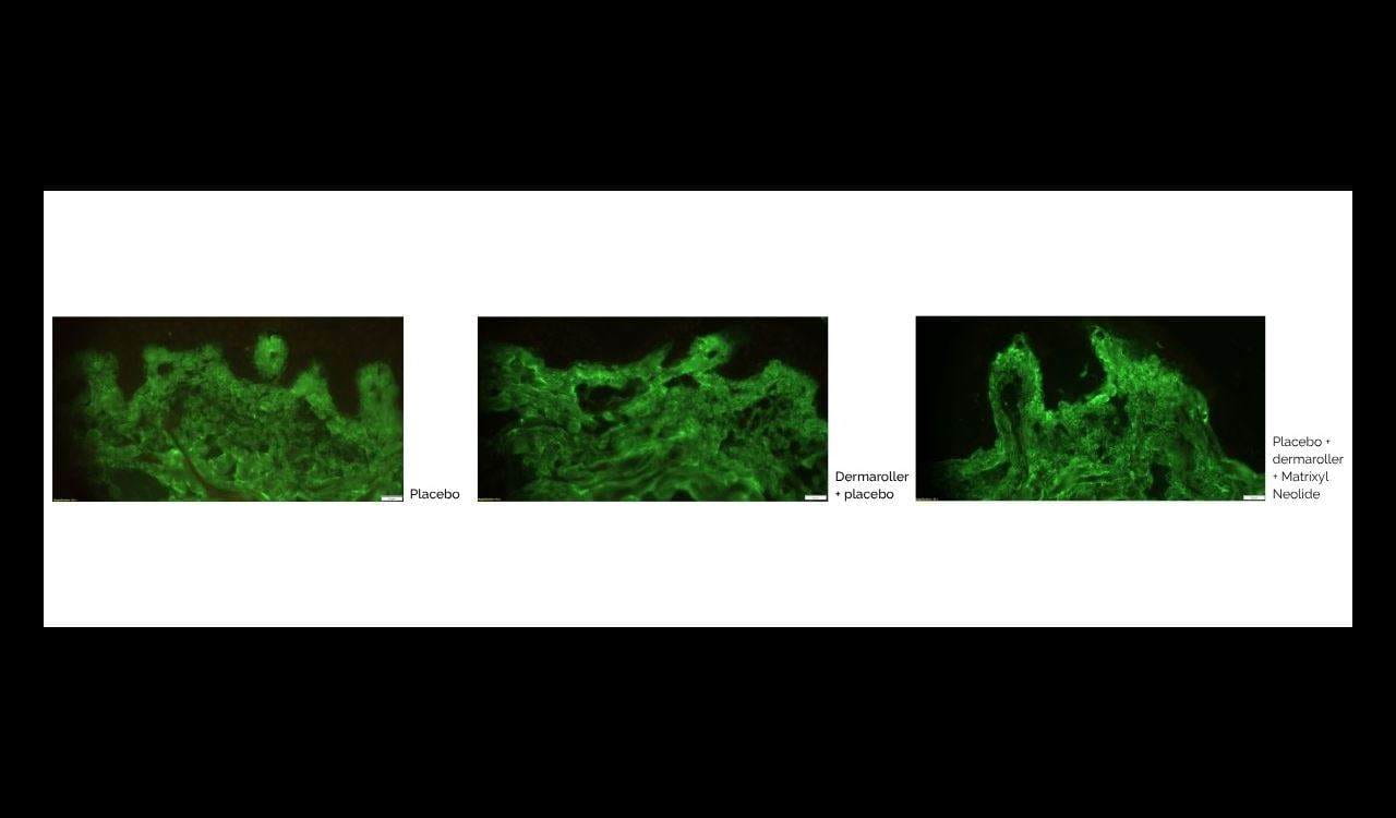 Diagram comparing the amount of collagen produced by placebo, dermaroller and dermaroller + 3% matrixyl neolide treatments. The more the green colour,. the better the treatment. Diagram shows that dermaroller + 3% matrixyl neolide treatment is the most effective.