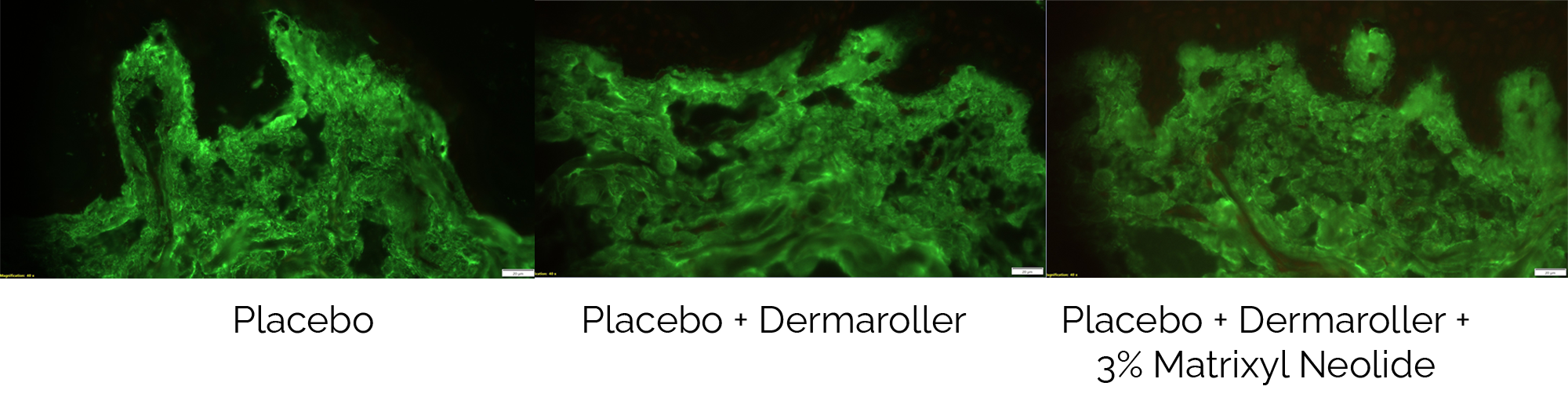 Diagram comparing the amount of collagen produced by placebo, dermaroller and dermaroller + 3% matrixyl neolide treatments. The more the green colour,. the better the treatment. Diagram shows that dermaroller + 3% matrixyl neolide treatment  is the most effective.