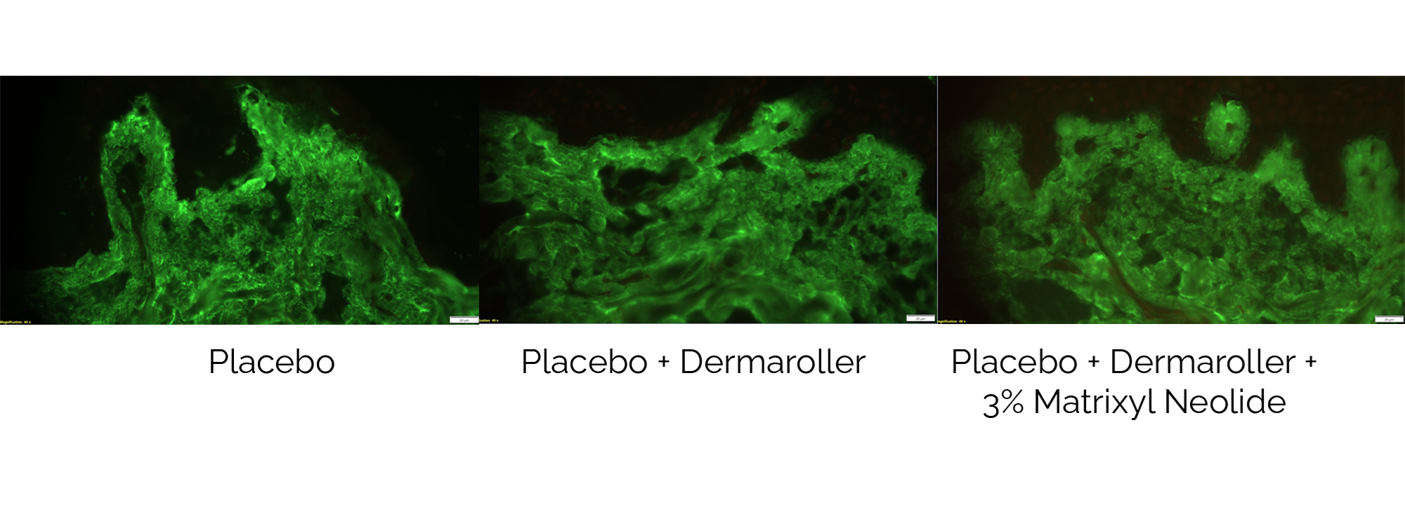Diagram comparing the amount of collagen produced by placebo, dermaroller and dermaroller + 3% matrixyl neolide treatments. The more the green colour,. the better the treatment. Diagram shows that dermaroller + 3% matrixyl neolide treatment is the most effective.