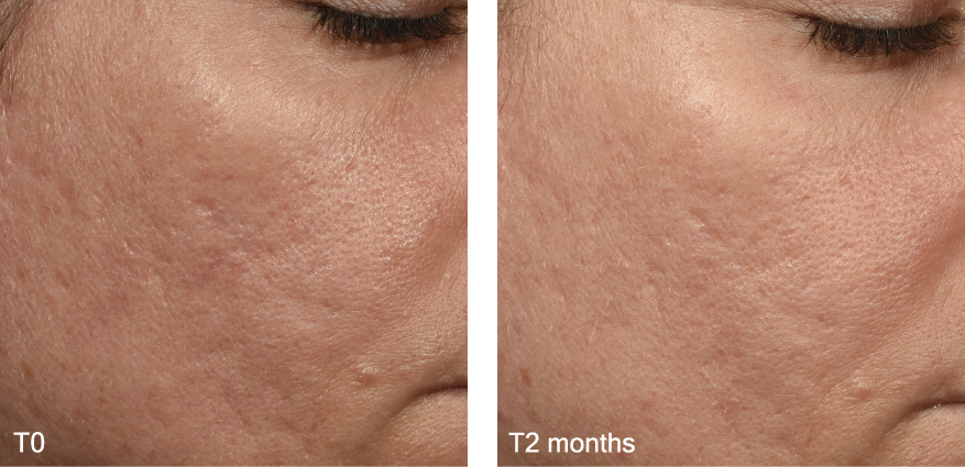 BB-Biont BeforeAfter