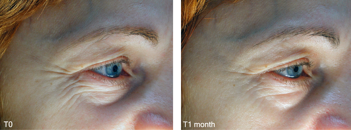 Matrixyl 3000 BeforeAfter