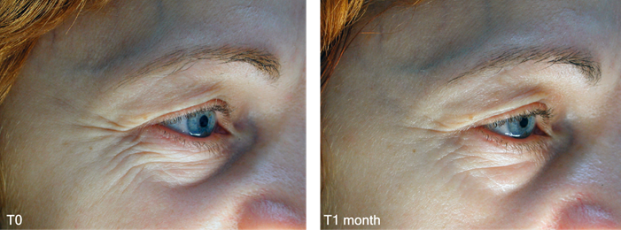 Matrixyl 3000 BeforeAfter