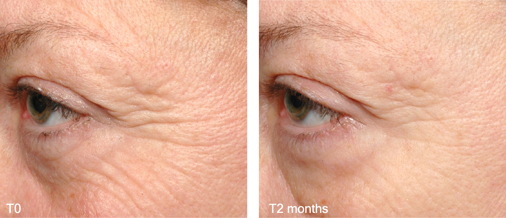 MatrixylSynthe'6BeforeAfter