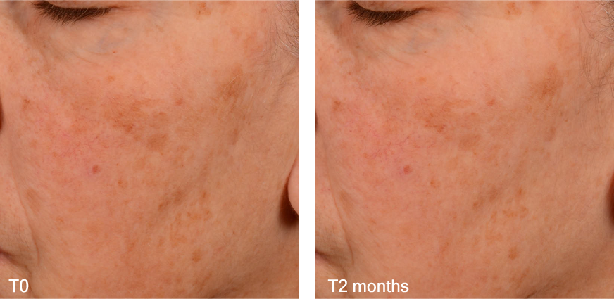 MelostemBefore/After