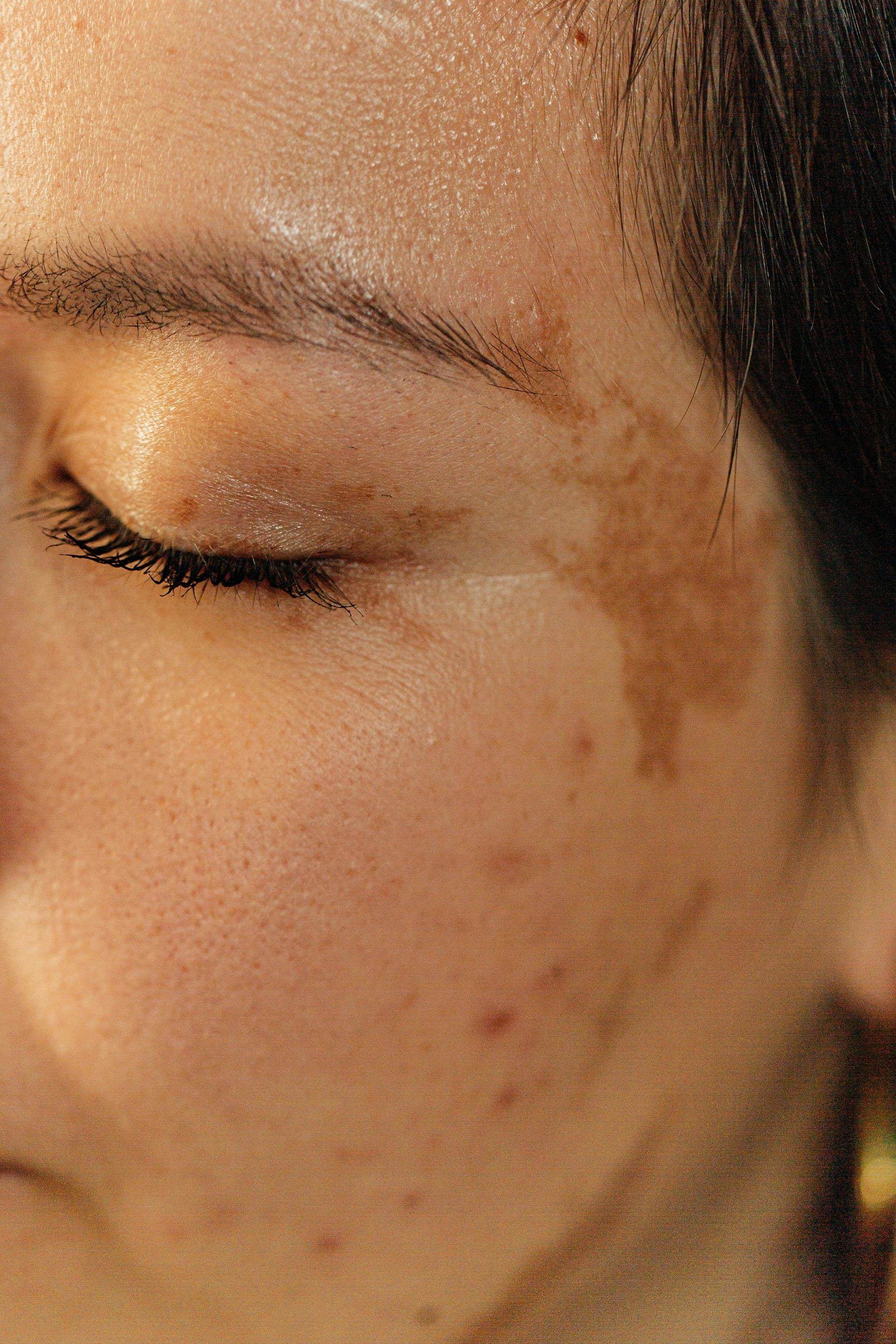 face with pigmentation in sun light