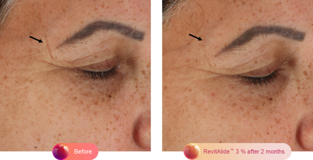 A comparison image. On the left we have a close up on an older woman's eye. An arrow indicates an impression (wrinkle) in her skin by the back of her eye. On the next image this wrinkle is gone. A caption reads "before" on the first image and "Revitalide™ 3% after 2 months" on the second image.