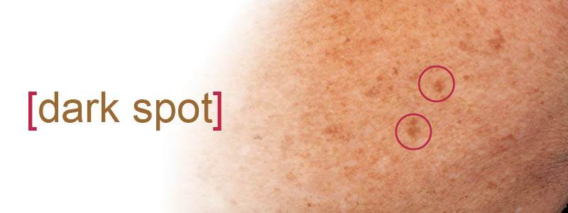 image of white and dark spots on white skin