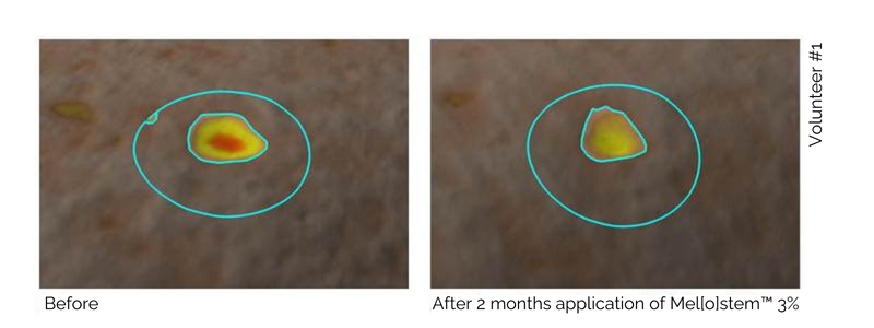 Diagram showing a reduction after 2 months of application of the lesion volume by 93% after application of mellostem.