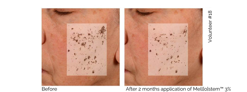 2 photos of an older white woman's face showing the fading of dark spots with Mel[o]stem™. On the left we see the dark spots highlighted, On the right we see the same area highlighted and a clear reduction in dark spots. 