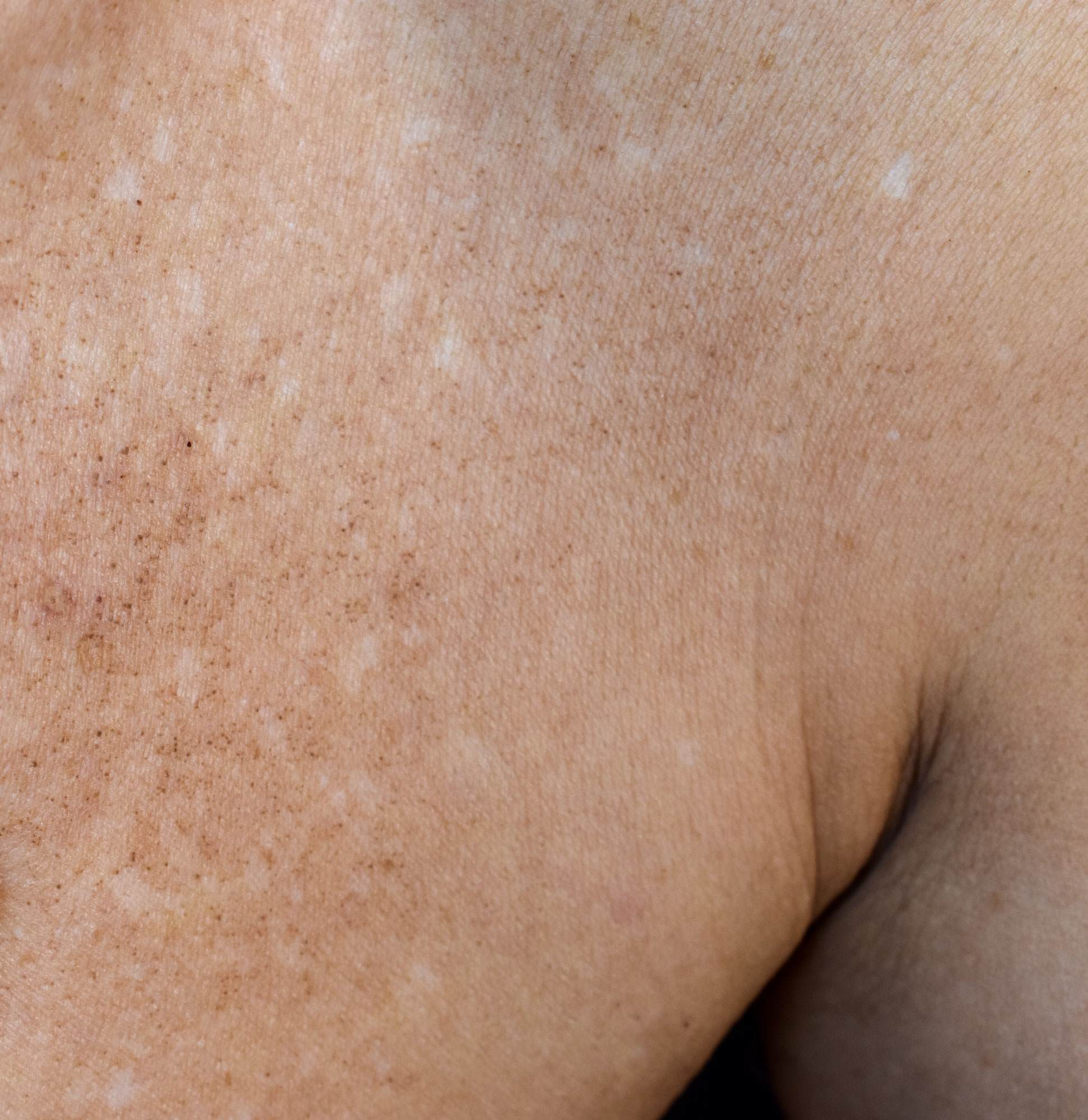 Close up on white skin showing white and dark spots.