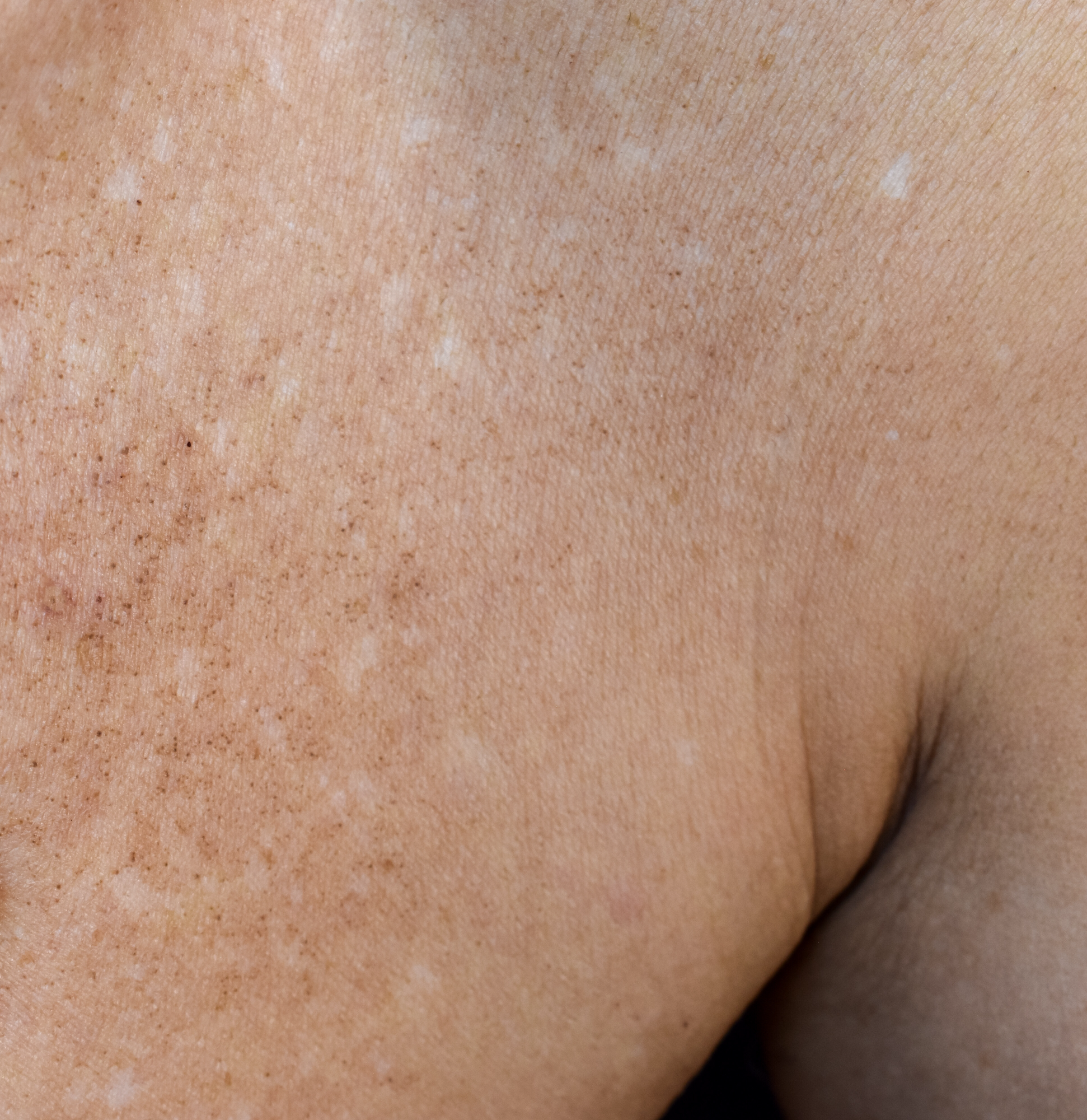 Close up on white skin showing white and dark spots.