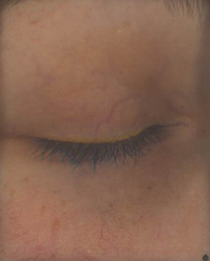  AMEYEZING™使用前