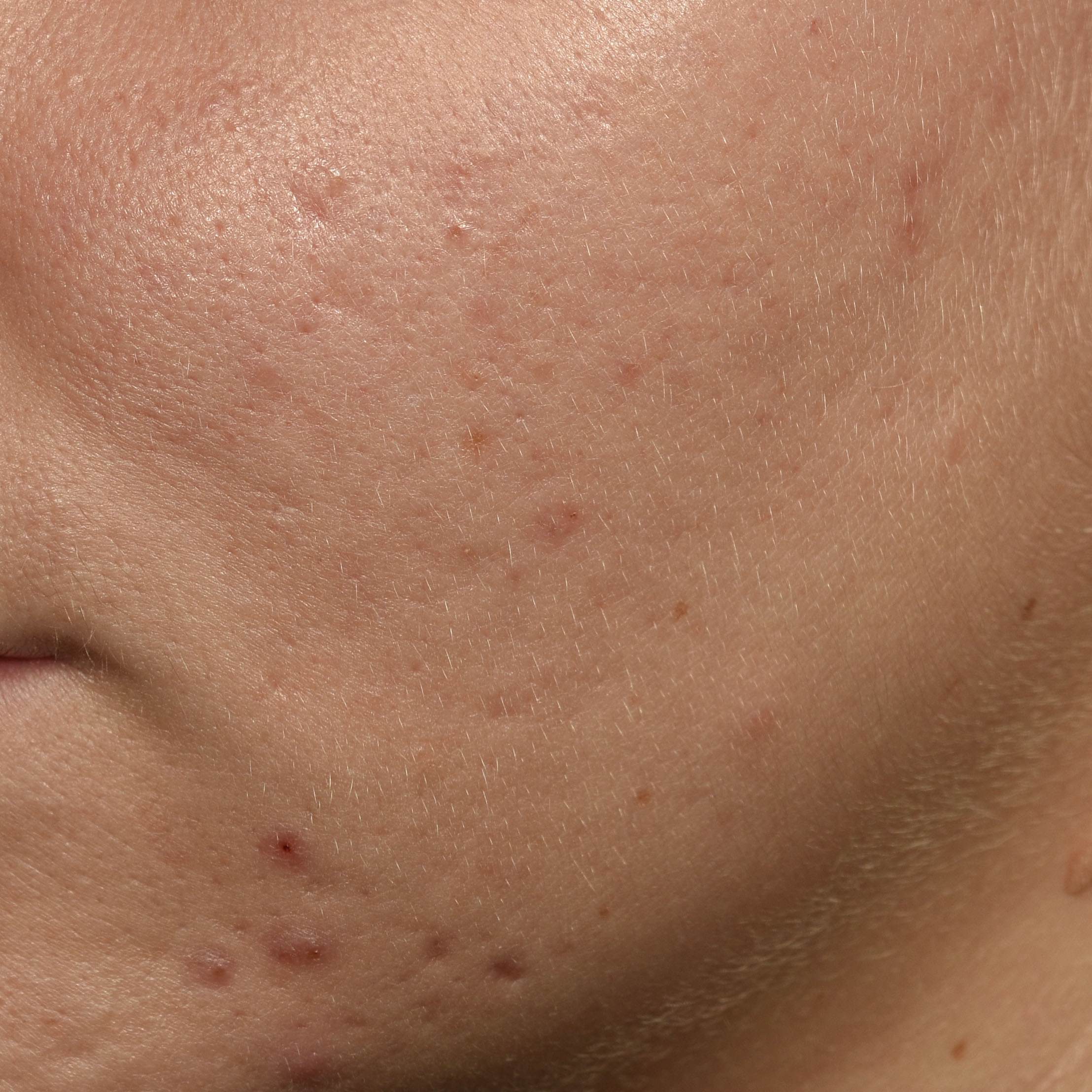 skin before applying BB-BIONT™ 1%