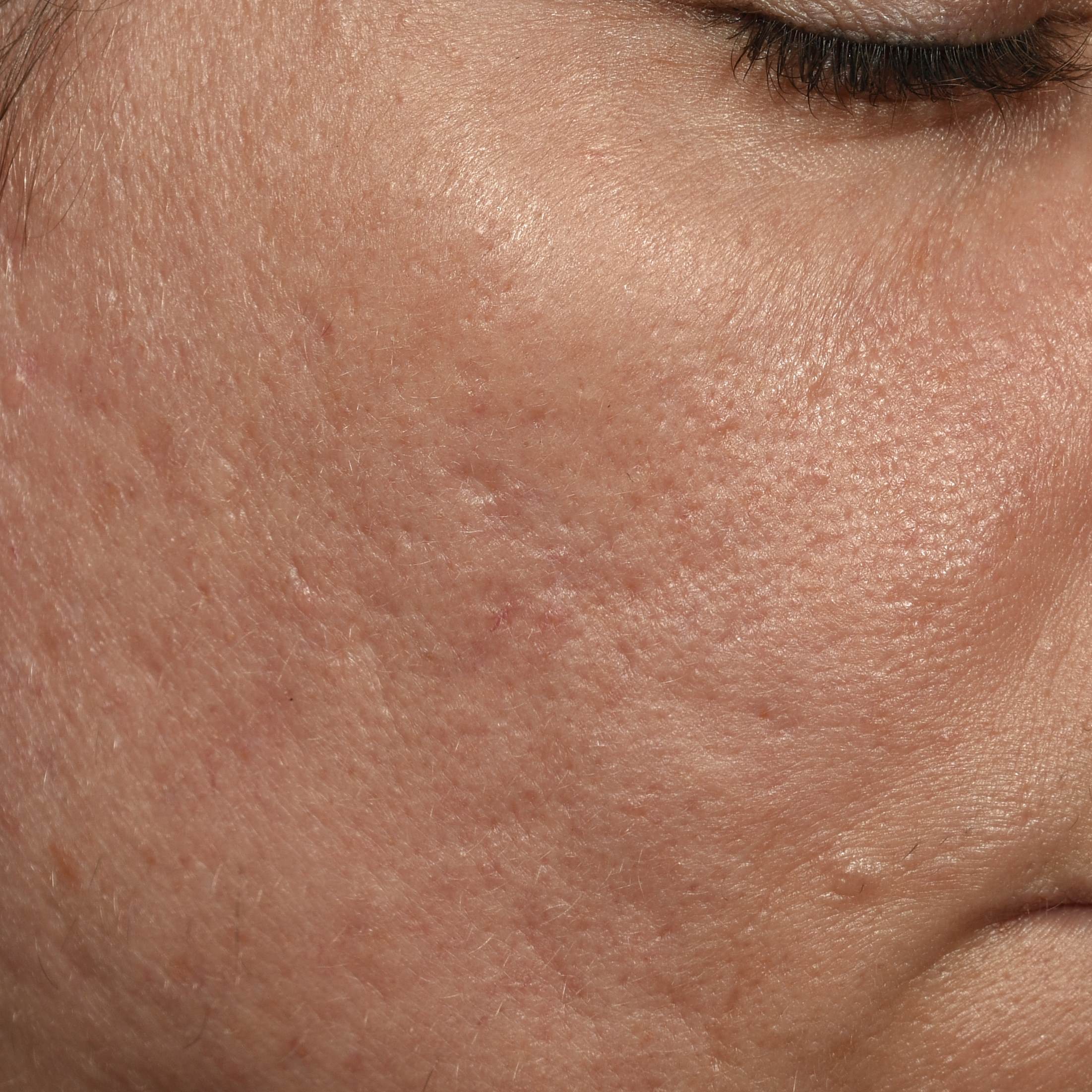 skin before applying BB-BIONT™ 1%