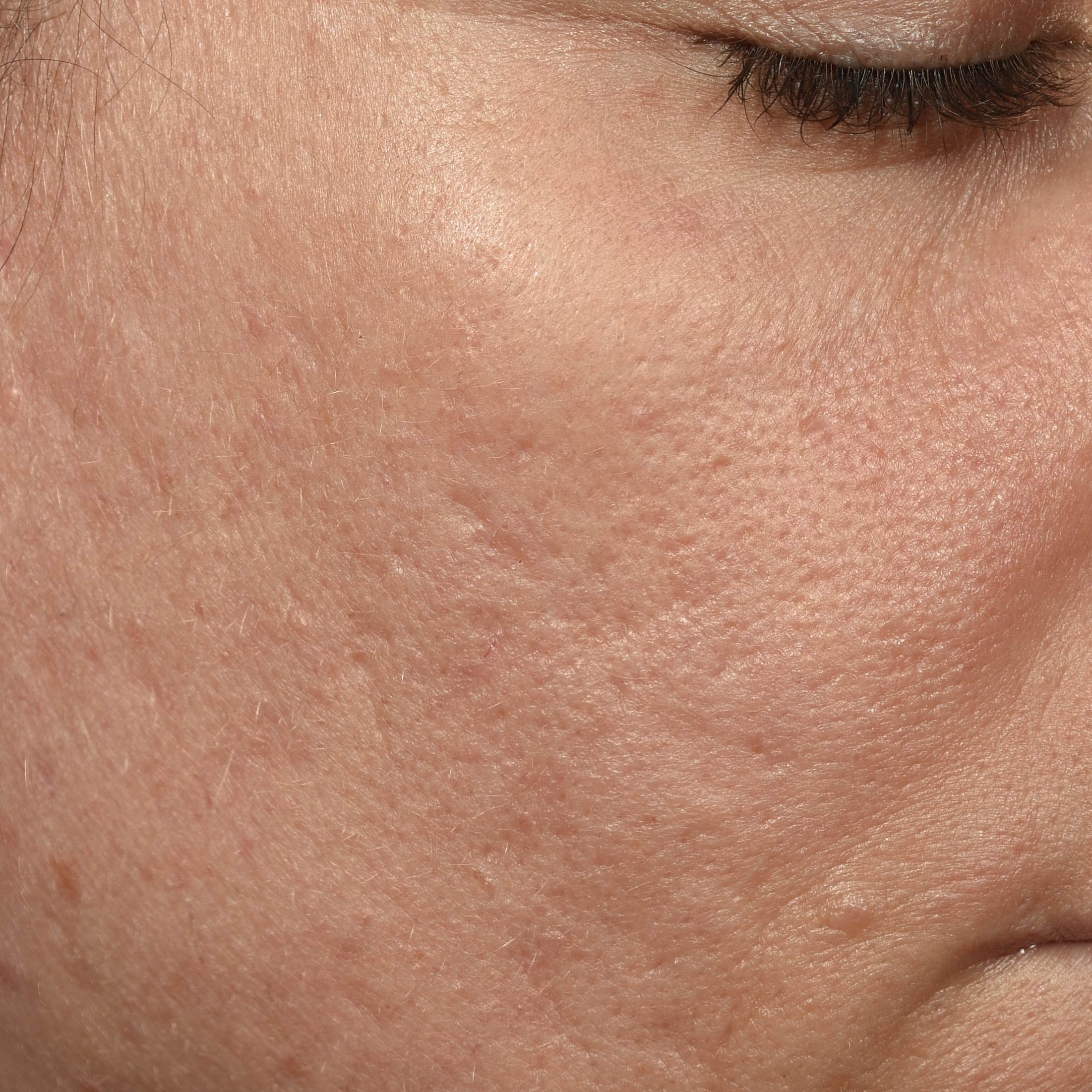 After 2 months applying BB-BIONT™ 1%