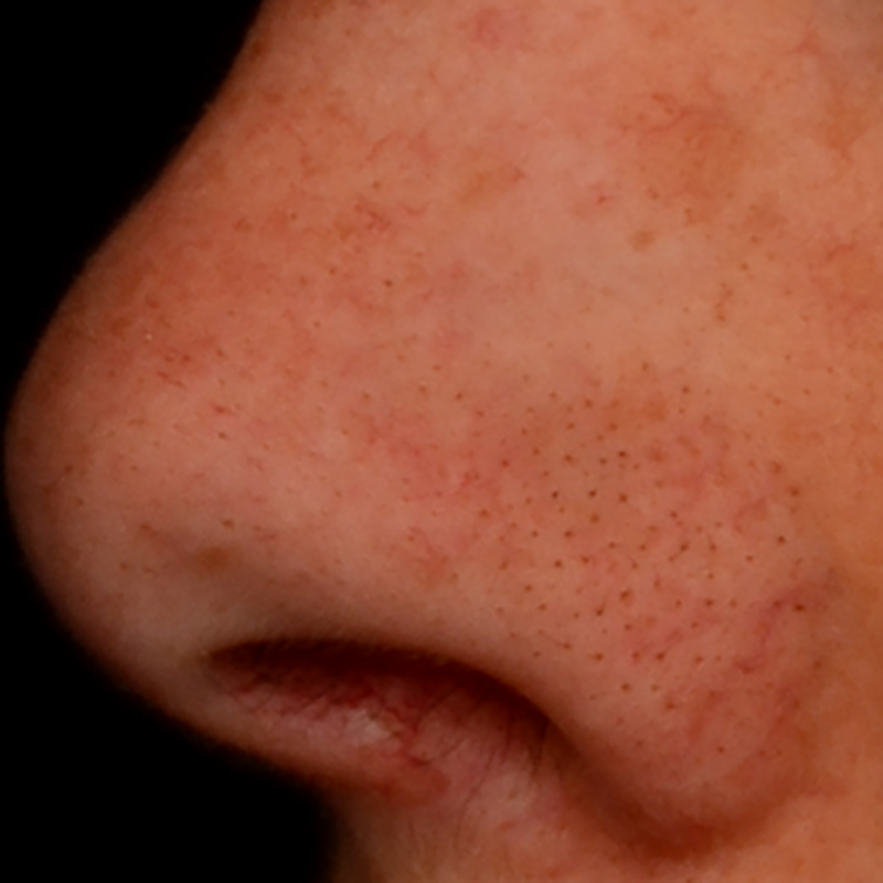 Before applying CITYSTEM® 2%