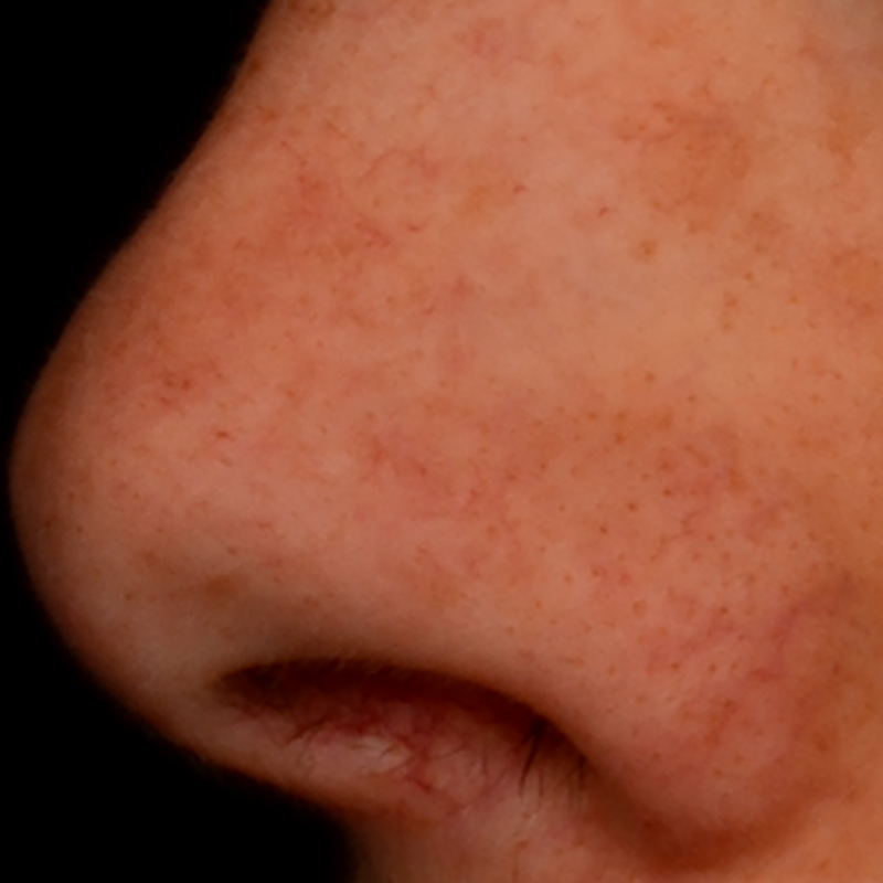 After applying CITYSTEM® 2% in a facial sheet mask applied once for 10-15 minutes.