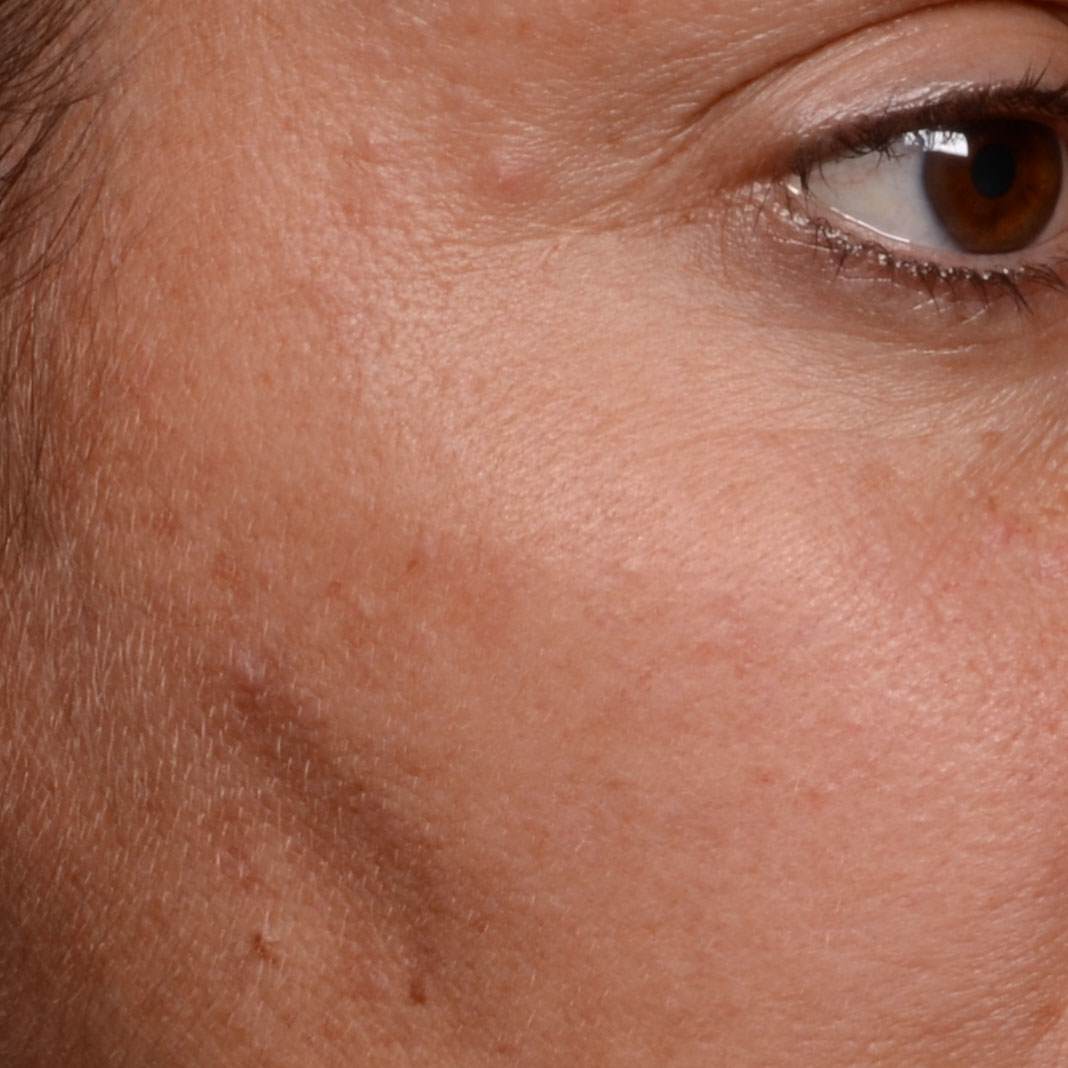 before APPLYING CRYSTALIDE® 3 %