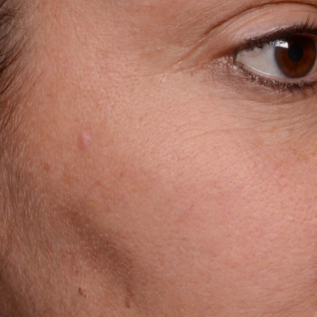 After APPLYING CRYSTALIDE® 3 %