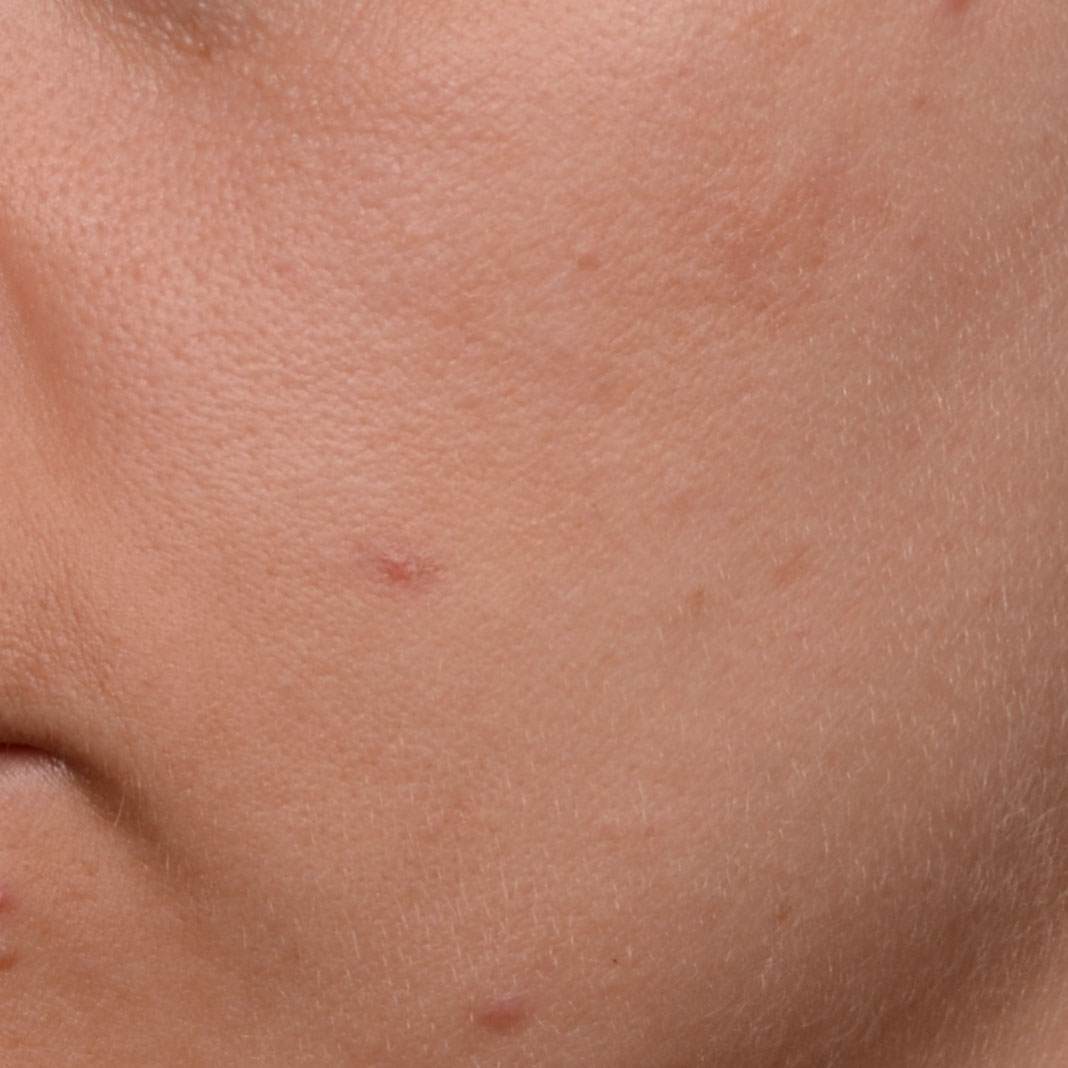 Before  APPLYING CRYSTALIDE® 3 % photo2