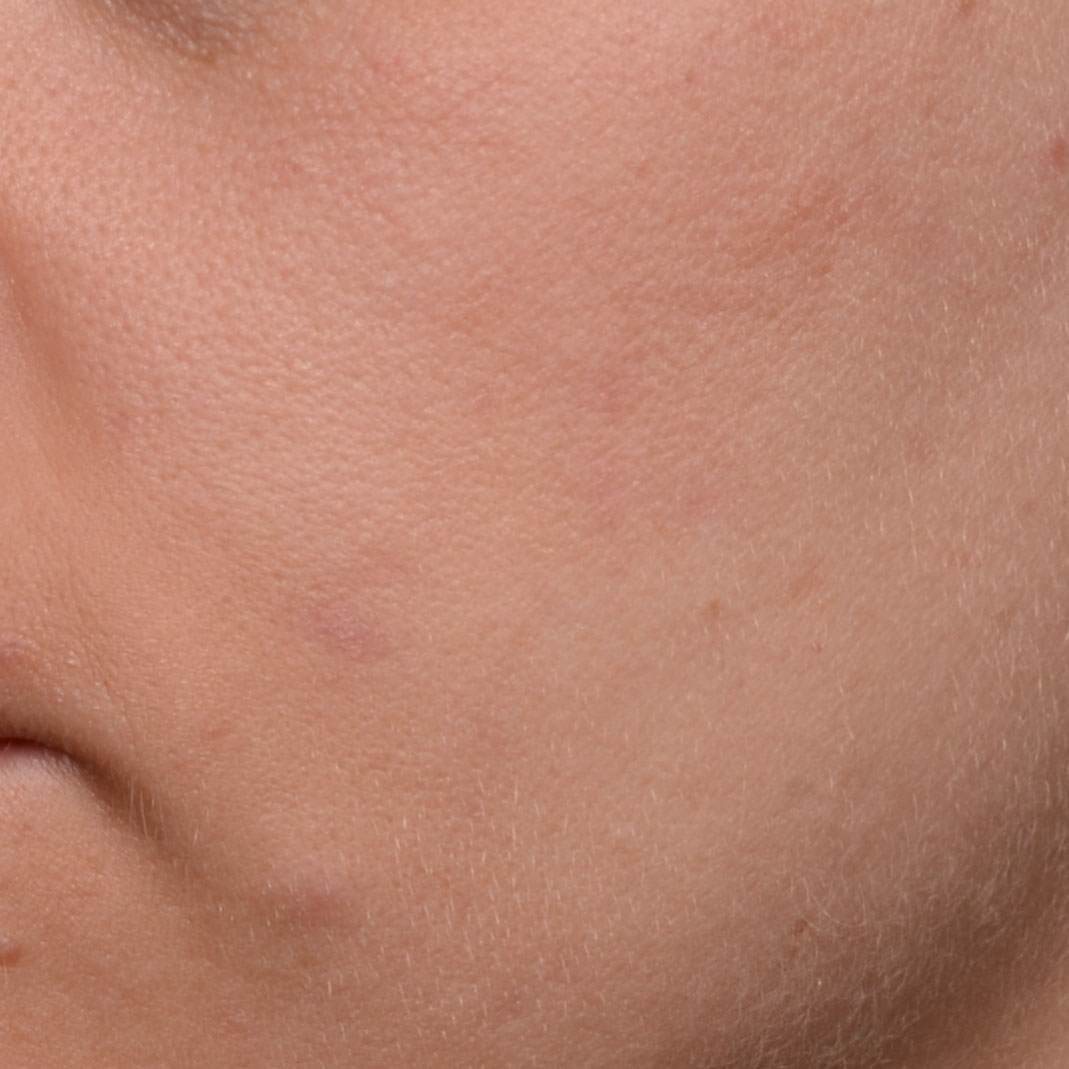 After APPLYING CRYSTALIDE® 3 % photo2