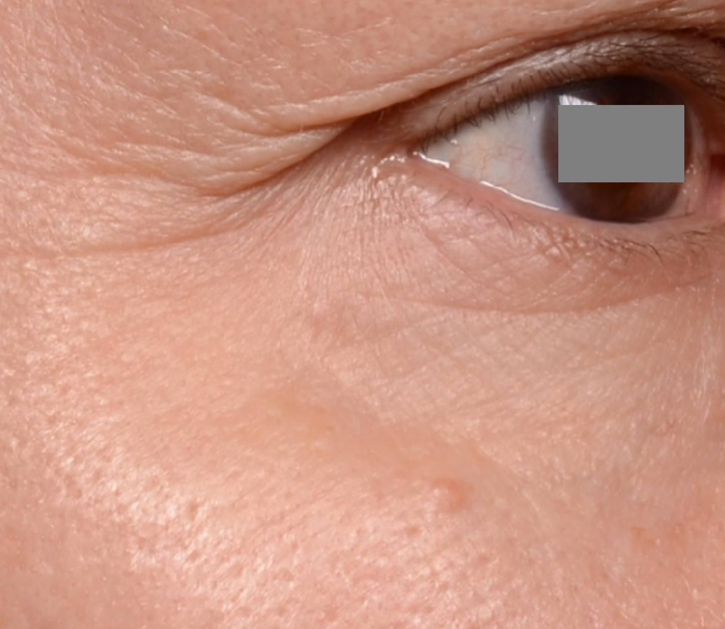 After 2 months withMAJESTEM® DRYPURE™ 0.03%