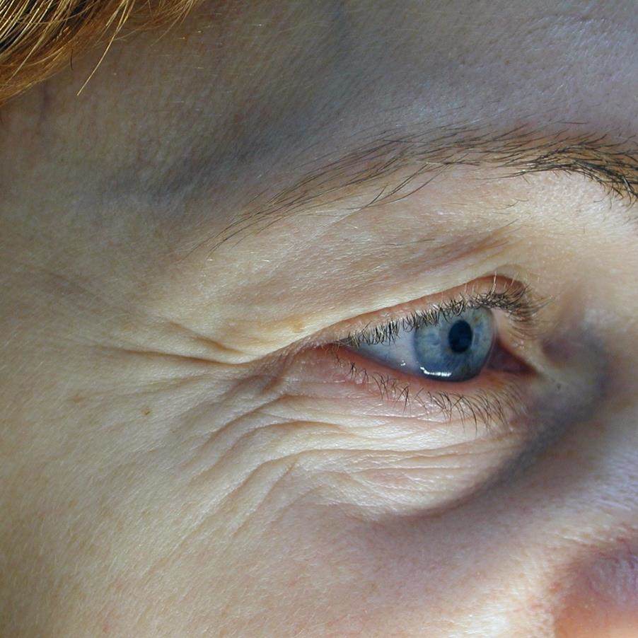 can glp-1 be used in type 1 diabetes Scripts for GLP-1, SGLT2 Drugs on the Rise in Type 1 Diabetes Patients can glp-1 be used in type 1 diabetes Scripts for GLP-1, SGLT2 Drugs on the Rise in Type 1 Diabetes Patients