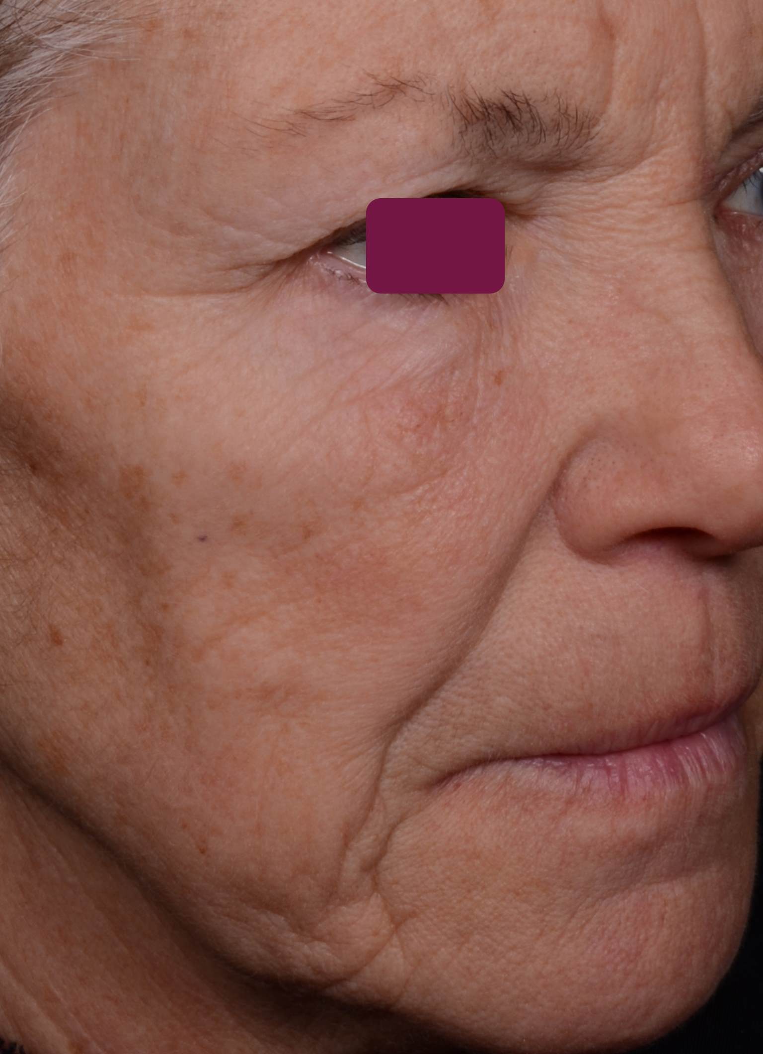 Matrixyl® Morphomics®使用前