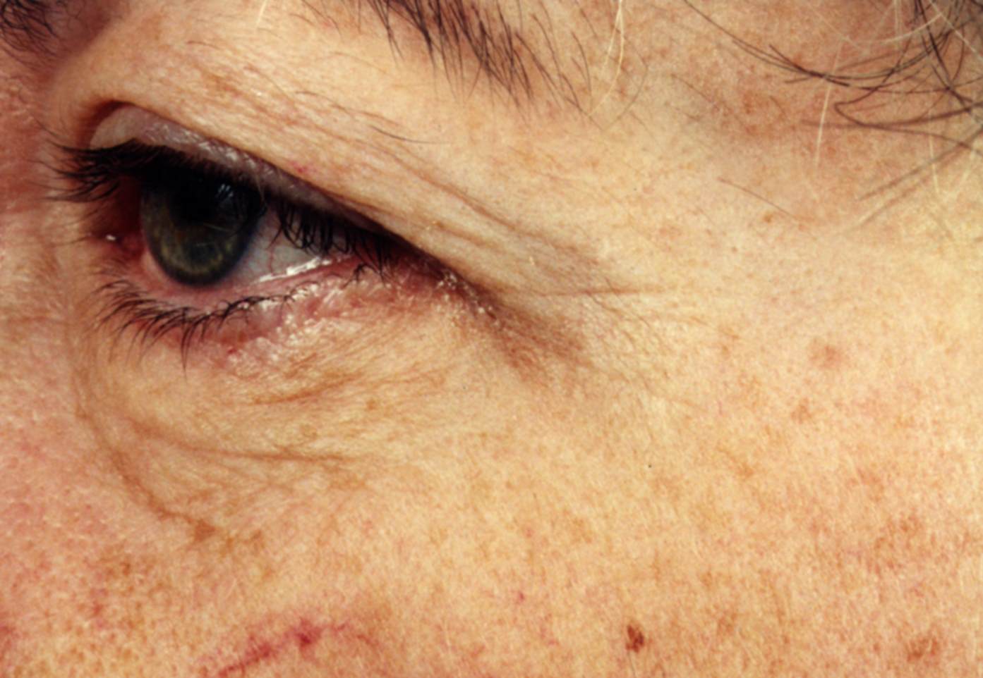 Matrixyl_visualise the results after 6 months