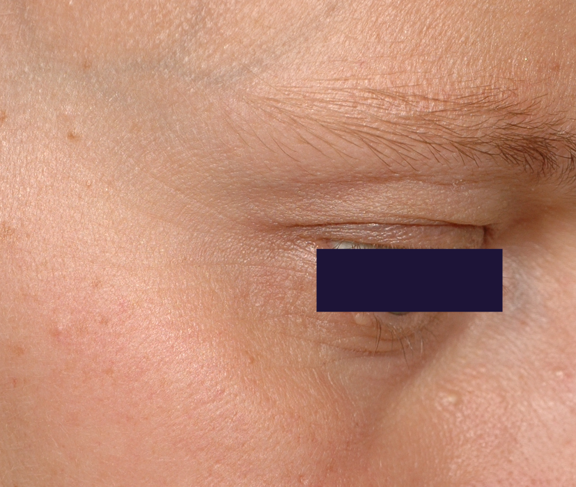 オプティムヒアル 0日目