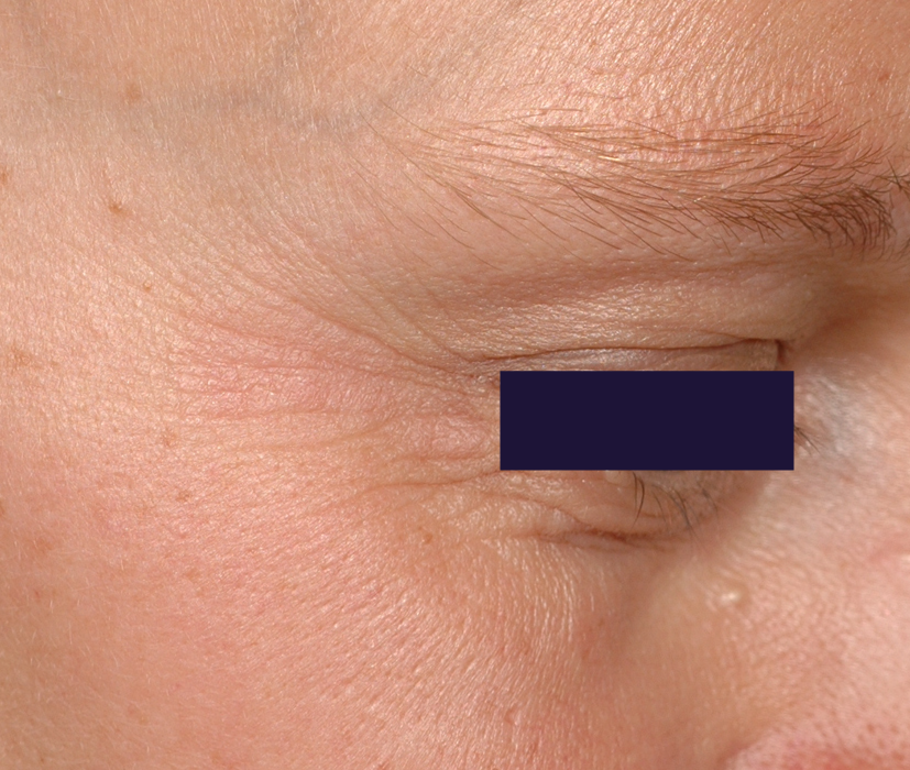 オプティムヒアル 3週間後