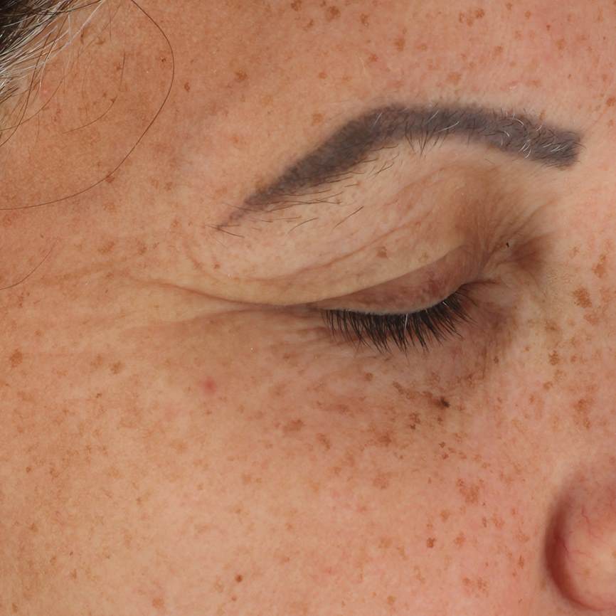 ReVitAlide™ results after 2 months