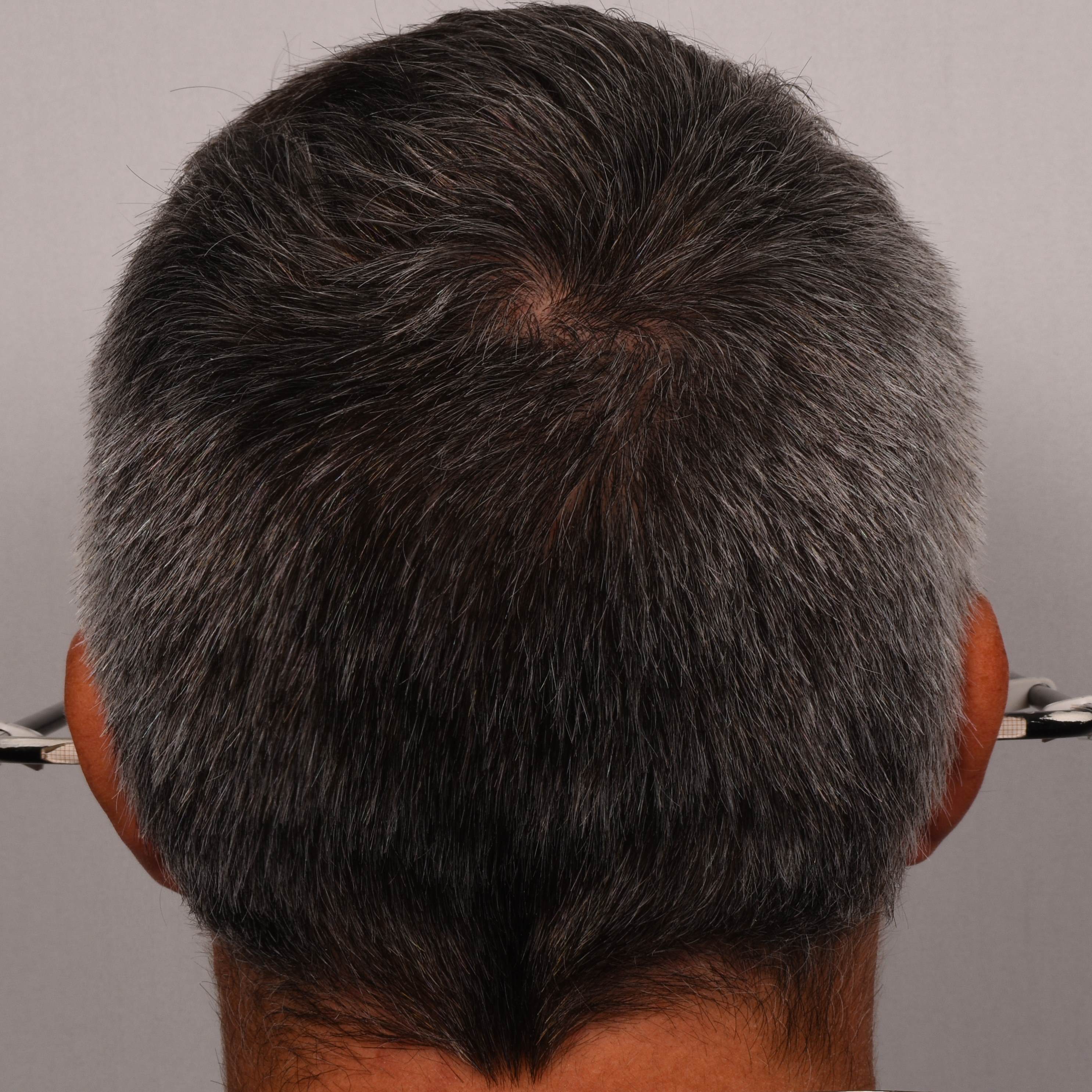  hair melanisation before applying SILVERFREE™ 