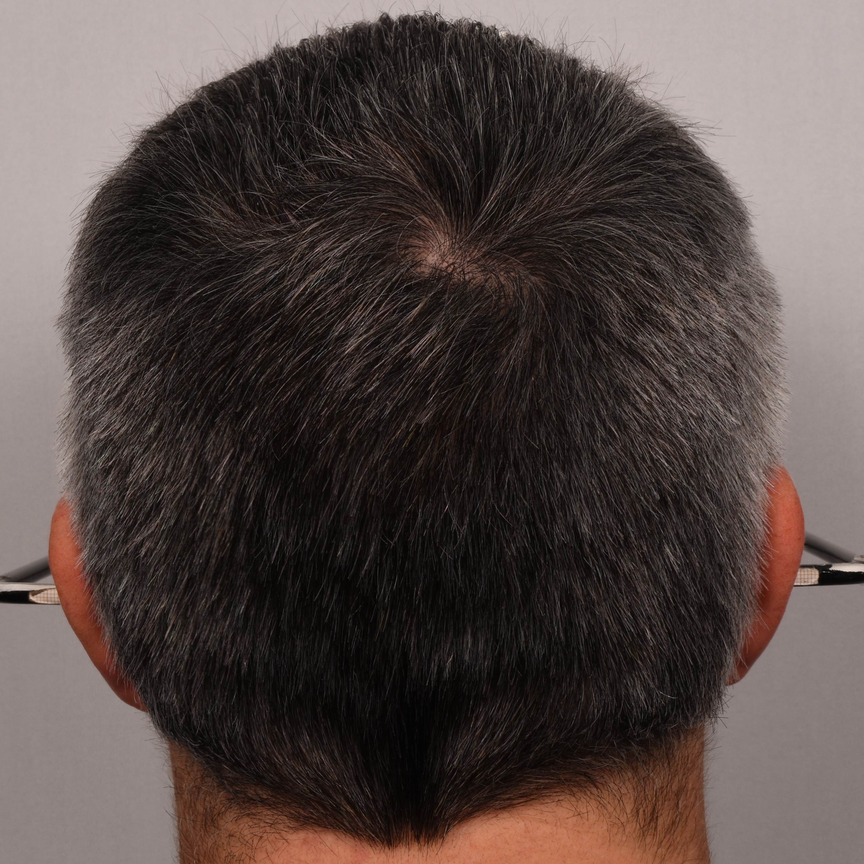  hair melanisation after applying SILVERFREE™ 