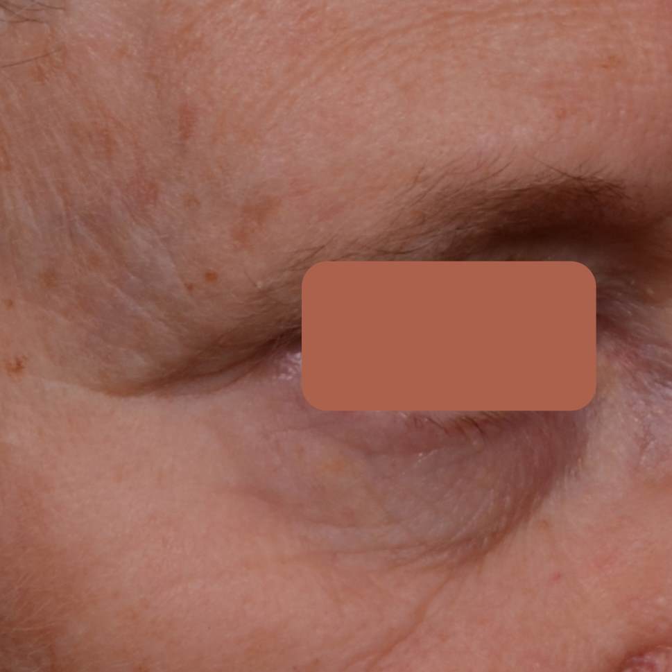 Before applying Synchrolife 