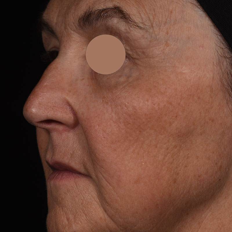 After image in greyscale and close up of an older woman's face showing wrinkles have been reduced after application of matrixyl neolide.