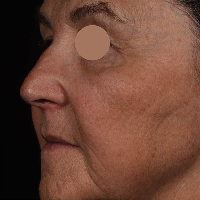 Before image in greyscale and close up of an older woman's face showing wrinkles