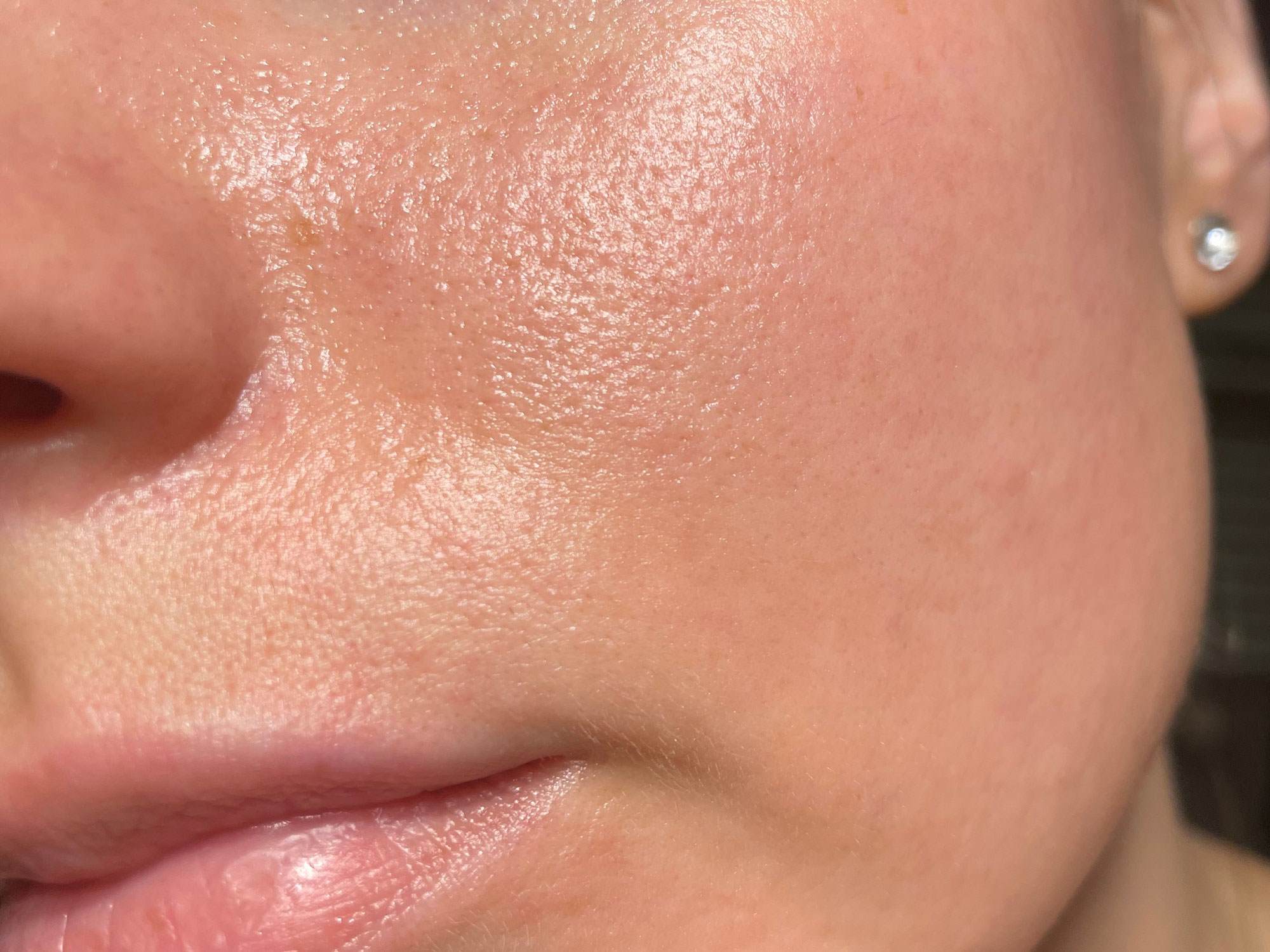 Close up on shiny face with prominent pores