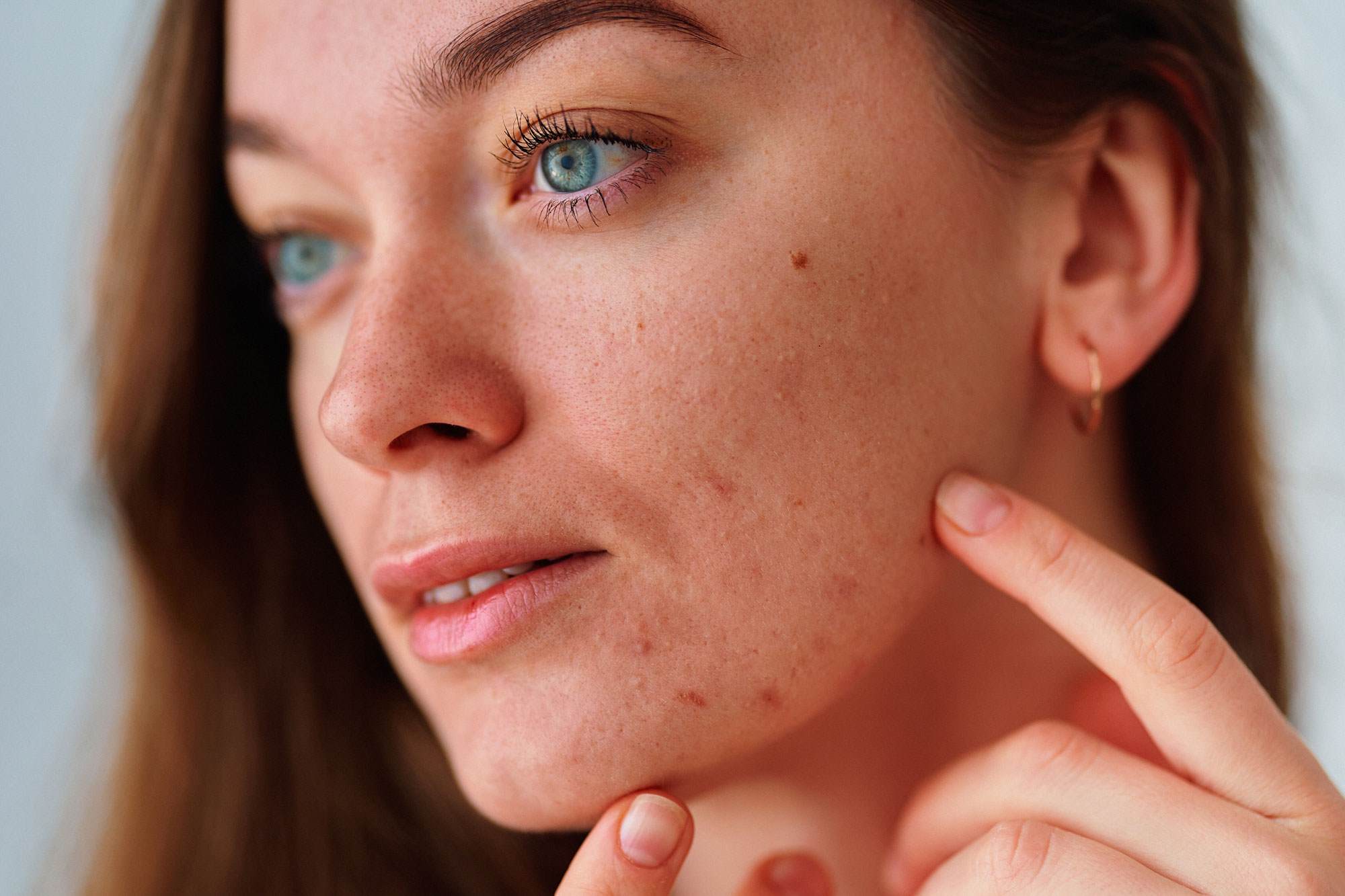 White woman with brown hair touching her face which has anoticeable sensitive skin breakout